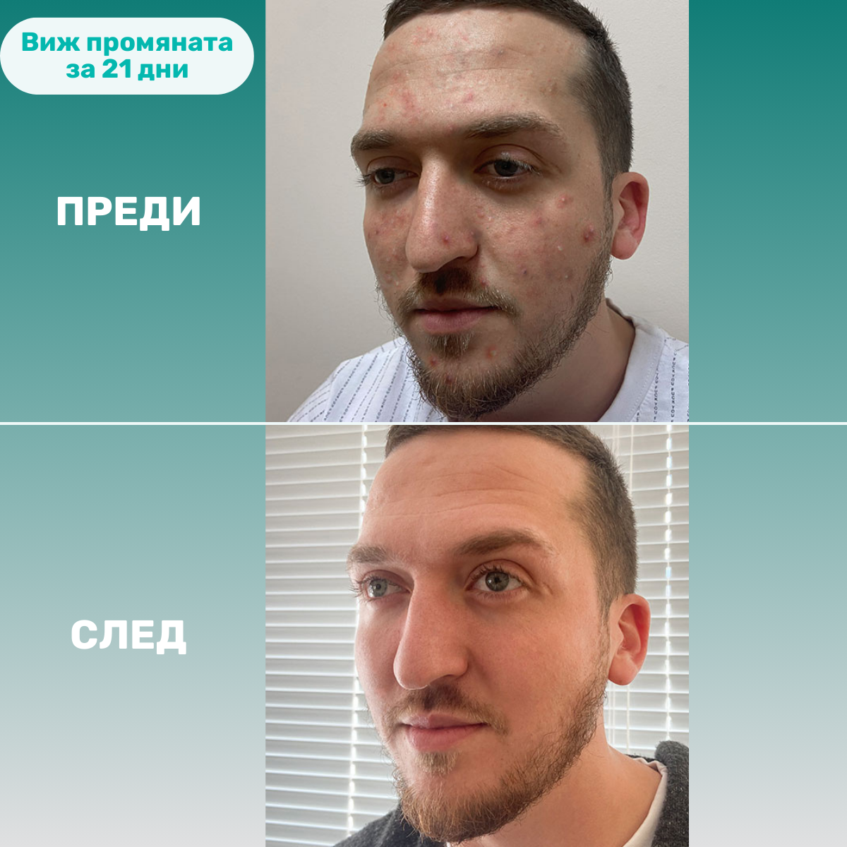 beMe Хидратиращ Крем – Възстановяване и защита на кожната бариера
